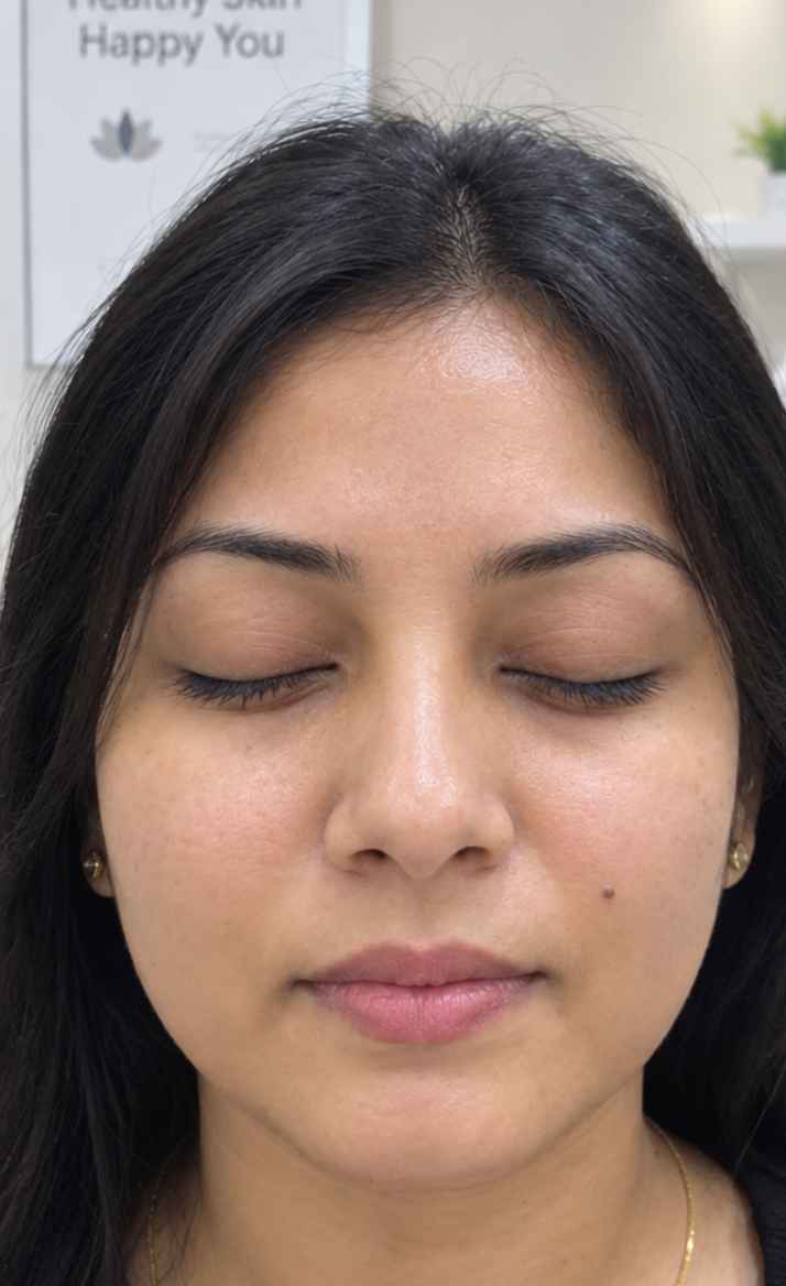 After Hydra Facial — Sneha T.