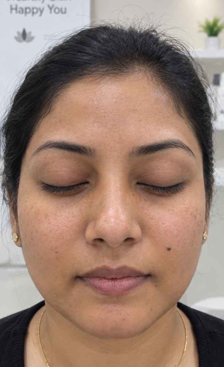 Before Hydra Facial — Sneha T.